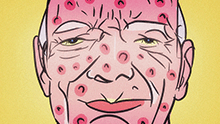 Homme ayant des boutons d'acné sur le visage