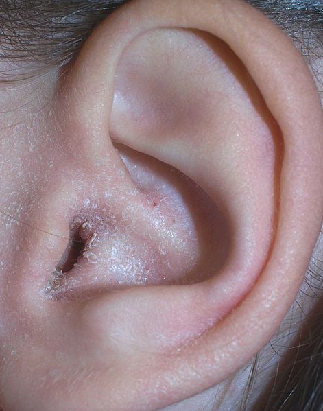 Comprendre et soigner l'eczéma de l'oreille