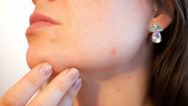 SOS acné à cause du masque : Comment soigner votre peau ?